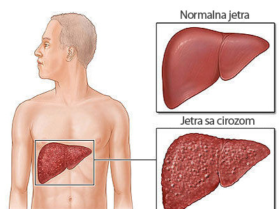 Proširene vene uzrokuju oštećenja jetre